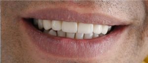 bridge post-op