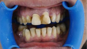 bridge pre-op